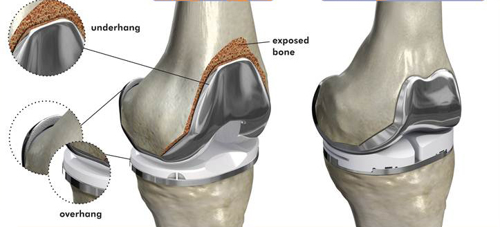 total knee diagram