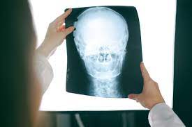 What is the Worth of a Traumatic Brain Injury Case in California